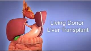 Medical Animation Living Donor Liver Transplant  Cincinnati Childrens [upl. by Ahsiekahs]