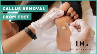 Callus removal from feet balls of feet [upl. by Gallagher]