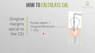 Dentiscope  HOW TO DETERMINE CLINICAL ATTACHMENT LOSS [upl. by Yttak]