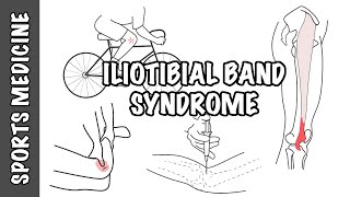 Iliotibial Band Syndrome ITBS  Overview [upl. by Anuahsar]