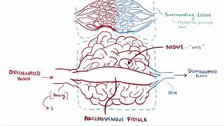 What happens after surgery for an arteriovenous malformation [upl. by Ahseit]