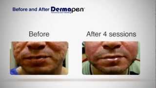 MicroNeedling Before and After  Dermapen® Treatment [upl. by Horwath367]