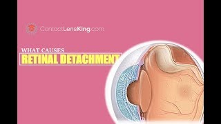 What Causes Retinal Detachment [upl. by Itsur]