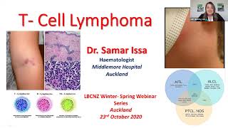 A step forward in the treatment of myelofibrosis [upl. by Anders879]