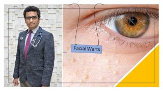 Facial Warts In Children [upl. by Lorre942]