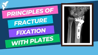 Principles of Fracture Internal Fixation With Plates and Screws  Material Properties [upl. by Kared]