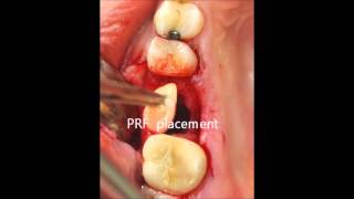 oroantral fistula closure [upl. by Coffee]