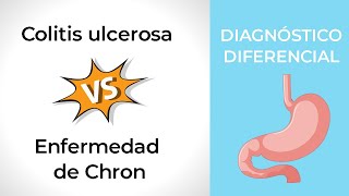 Diagnóstico Diferencial Colitis ulcerosa vs Crohn [upl. by Ueik813]