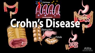 Crohns Disease Pathophysiology Symptoms Risk factors Diagnosis and Treatments Animation [upl. by Rist999]