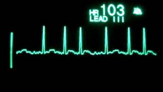 Atrial Fibrillation [upl. by Gwenn]