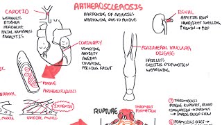 Atherosclerosis  Pathophysiology [upl. by Monah]