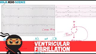 Rate and Rhythm  Ventricular Fibrillation [upl. by Ahtela721]