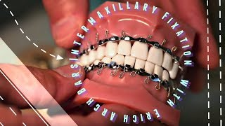 Intermaxillary Fixation with Erich Arch Bars [upl. by Tselec]