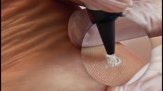 Plantar Wart Treatment [upl. by Ttiwed]