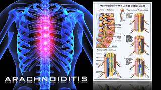 Epidural Steroid Injections amp Arachnoiditis  FDAPROP HEARING [upl. by Ayila]