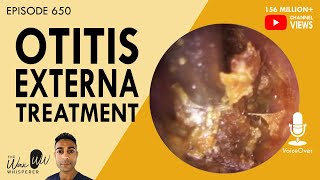 650  Treatment of Otitis Externa [upl. by Akkina]