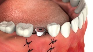 SIC invent Dental Implant Guideline for patients Abutment Single Tooth [upl. by Nashom164]