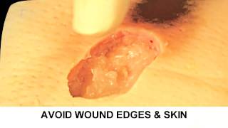 Enzymatic Debridement Demonstration Understand Wound Care [upl. by Yrehcaz]