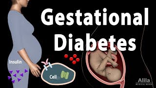 Gestational Diabetes Animation [upl. by Jens898]