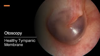 Tympanic Membrane Otosopy [upl. by Appolonia]