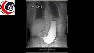 Barium Meal Follow Through Barium Procedure [upl. by Bibbye990]