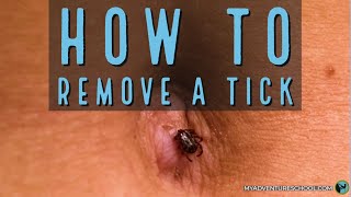 Tick Removal [upl. by Tony265]