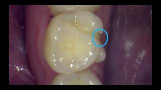 What does a cavity look like [upl. by Tamah]