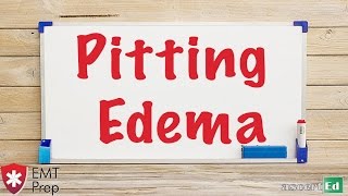 Pitting Edema  EMTprepcom [upl. by Adnaloj]