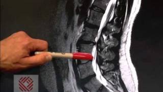 Low Back Pain Part 8 Spinal Stenosis [upl. by Tarrsus]