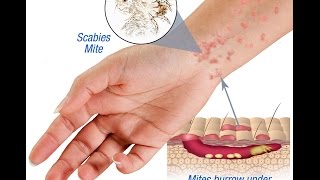 Scabies Causes Symptoms and Treatment [upl. by Mcnamara846]