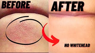 How To Remove Whiteheads And Blackheads From Chin At Home [upl. by Jerman667]