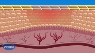 Dermalex Rosacea  How it works [upl. by Kosel]