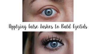 Applying False Lashes to Bald Eyelids Trichotillomania  G Beauty [upl. by Serrano609]