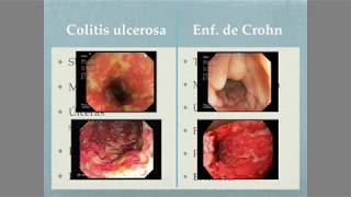 Colitis ulcerosa Vs Enfermedad de Crohn [upl. by Inalan603]