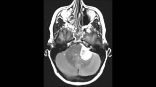 Schwannoma vestibular [upl. by Warrin]