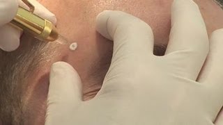 Removing warts how to [upl. by Eatnwahs]