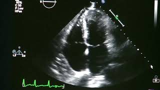 Atrial Fibrillation On Echocardiogram [upl. by Odnomor325]