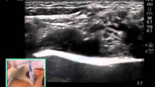 ULTRASOUNDGUIDED SUPRACLAVICULAR NERVE BLOCK [upl. by Oneal]