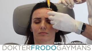 Botox behandeling frons voorhoofd en kraaienpootjes [upl. by Erasme]