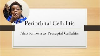 Periorbital Cellulitis Emergency [upl. by Karia]