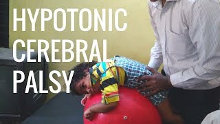 What is cerebral palsy [upl. by Neeham]