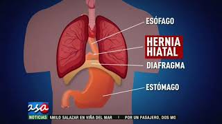 ¿Qué es la hernia hiatal [upl. by Martita]