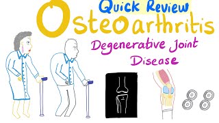 Osteoarthritis OA  Degenerative Joint Disease  Quick Review  Rheumatology Playlist [upl. by Atkins207]