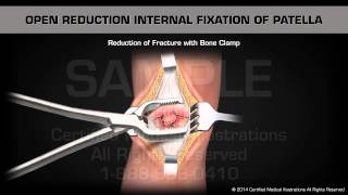 Open Reduction Internal Fixation of Patella [upl. by Manup127]