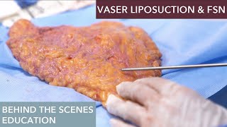 The Science Behind Vaser Liposuction How Does It Work [upl. by Eirdua468]