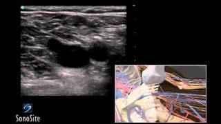 How To Deep Vein Thrombosis Ultrasound Exam 3D Video [upl. by Aelat]