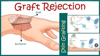 Graft rejection  Immunological basis of graft rejection [upl. by Civ]