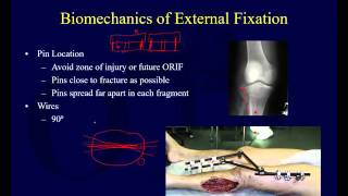 Orthopaedic Implants 2  External Fixation [upl. by Ablem533]