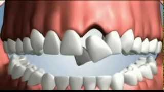 4 Options to Replace a Tooth [upl. by Leftwich]