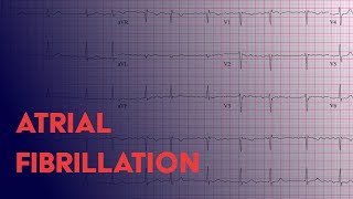 Atrial Fibrillation Afib  EKG ECG Interpretation [upl. by Darcy44]